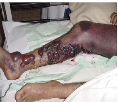 Figure 3. A 28-year-old patient admitted to the hospital after a snakebite in the  region of Ouarzazate (south of Morocco)