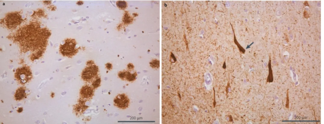 Figure 9. Representation of microscopic hallmarks of AD. (a) Senile plaques and (b) neurofibrillary  tangles (Aguzzi and O'Connor 2010).
