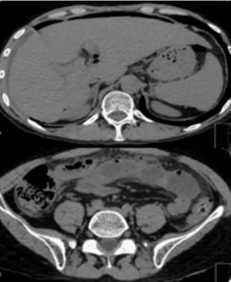 Figure  3:  CT  scan  showing  intra-peritoneal  fluid  pneumoperitoneum and bowel perforation  