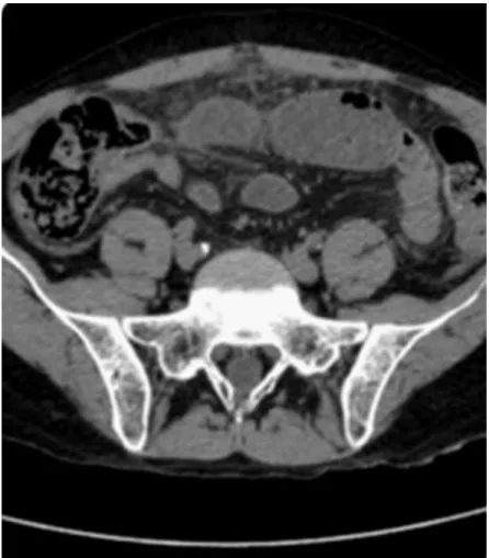 Figure 4: CT scan showing bowel thickening  