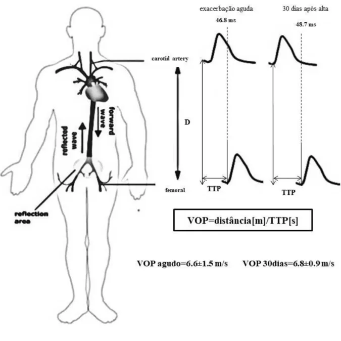 Figura 4 - Ilustração dos valores médios±DP das variáveis tempo de trânsito de pulso (TTP) e  velocidade  de  onda  de  pulso  (VOP)  nos  momentos  de  exacerbação  aguda  e  recuperação