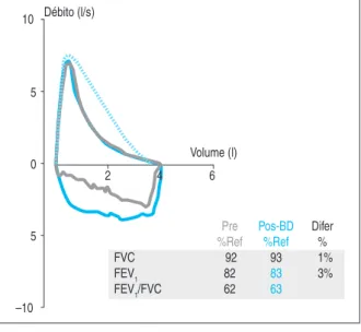 Figura 1. Espirometria – DPOC – estádio GOLD I.