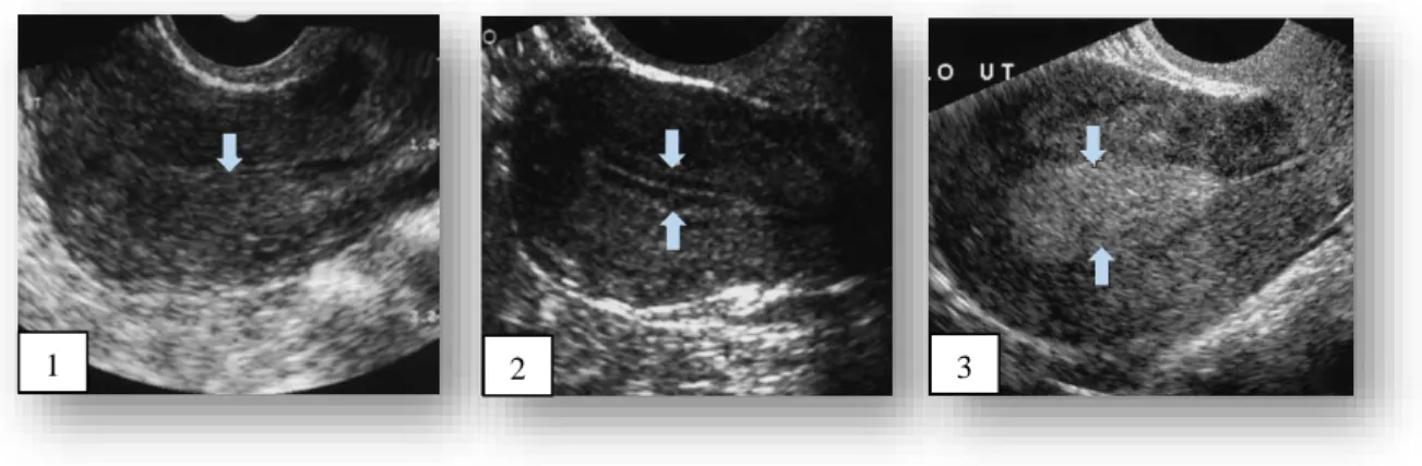 Figura 4 Diferentes fases de espessura do endométrio no caso de um endométrio prévio à menopausa