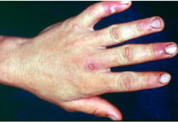 Figure 12: Presence of important  erythema and pustular   lesion in the fifth finger. 