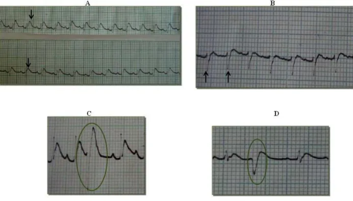 Figure 1. Electrocardiographic traces for animals subjected to experimental  envenomation using Tityus serrulatus venom; (A) increased T wave at ten minutes  for animals in both envenomed groups, (B) presence of an rS wave at ten minutes for  animals in gr