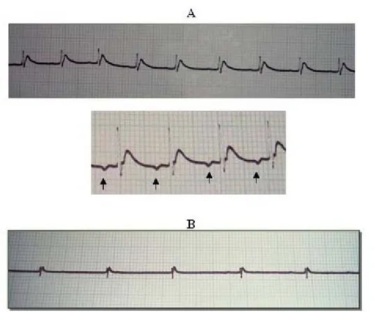Figure 2. Electrocardiographic traces of animals in group C, which were subjected to  experimental envenomation using Tityus serrulatus venom; (A) bradycardia at 25  minutes and inverted P wave (arrowed), and (B) accentuated bradycardia at 30  minutes