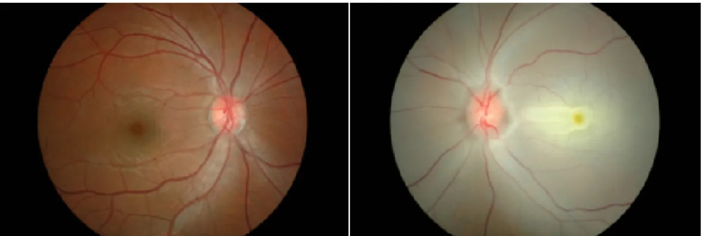 Figure 1. Fundus photograph showing marked whitish retina and a cherry-red spot at the macula of the  left eye