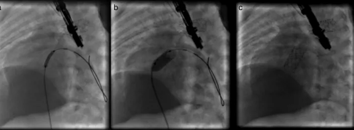 Figure 4 Angiographic images: (a) stent positioning at the level of the interatrial septum; (b) stent expansion; (c) fully expanded stent.