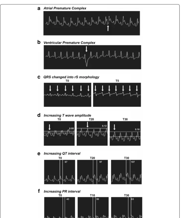 Fig. 3 Electrocardiogram alterations in animals treated with Hlsv. ECG from two animals of the treated group showing (a) atrial premature complex and (b) ventricular premature complex 15 min after the envenomation