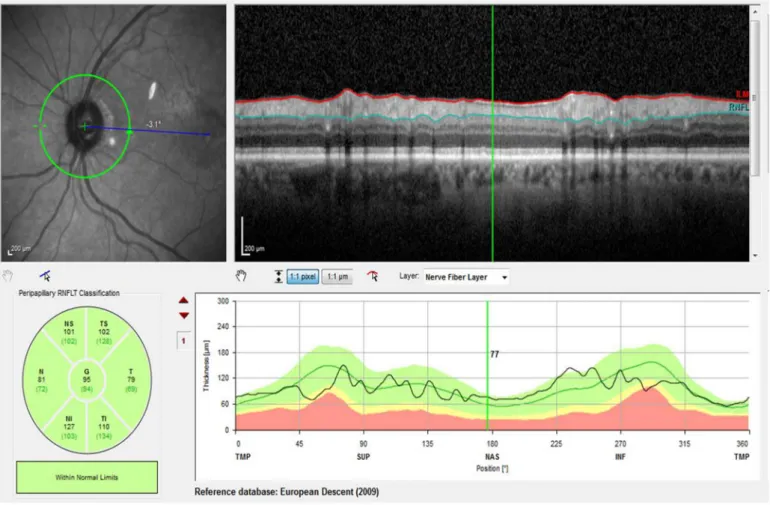 Fig. 2. Macular segmentation. Macular scan obtained with spectral domain optical coherence tomography, showing the segmentation of the various retinal layers