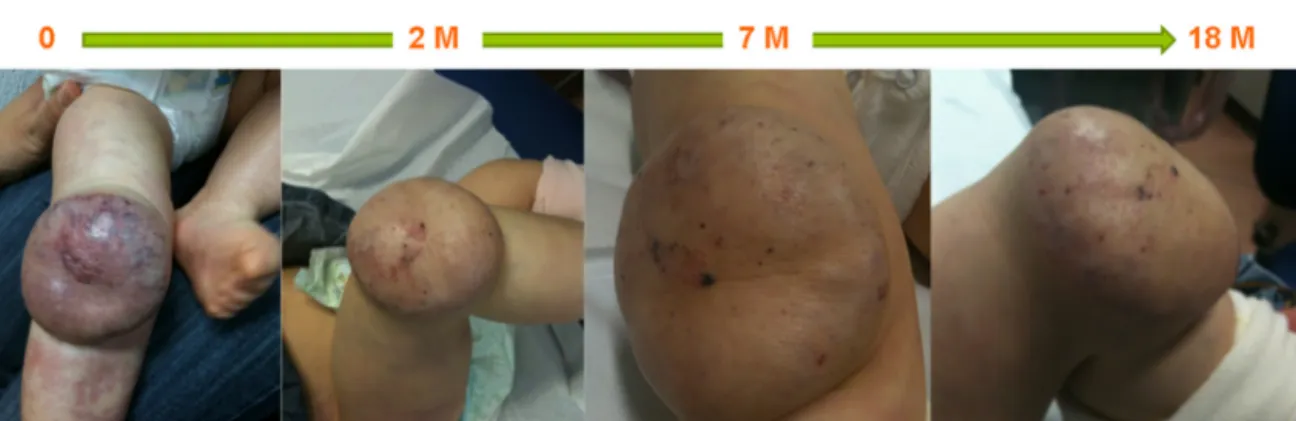 Figure 3 A ten-month-old boy with hemangioma on the right patella and upper right leg, showing a fair response after 18 months of therapy