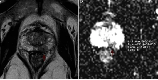 Figure 1 Example of ROI placement. Left peripheral prostate cancer in a 67-year-old man (PSA 9.5 ng/mL; Gleason Score of 8).