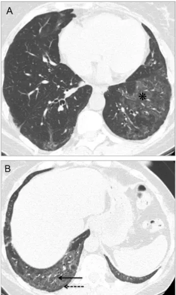 FIG 16. NSIP-like abnormalities in a 52-year-old woman with PM.