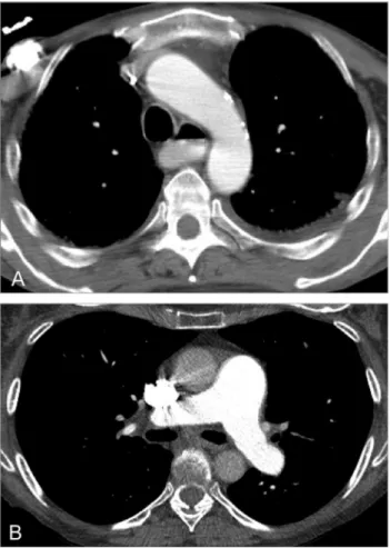 FIG 8. Extrapulmonary ﬁ ndings in SSc: (A) esophageal dilatation with air- ﬂ uid level in a 55-year-old man and (B) enlargement of the main pulmonary artery in a 62-year-old woman.
