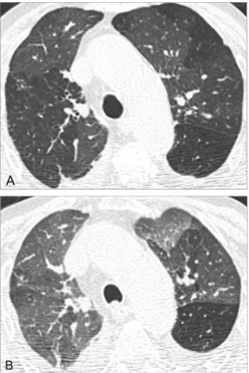 FIG 13. Constrictive bronchiolitis in an 84-year-old woman with RA.