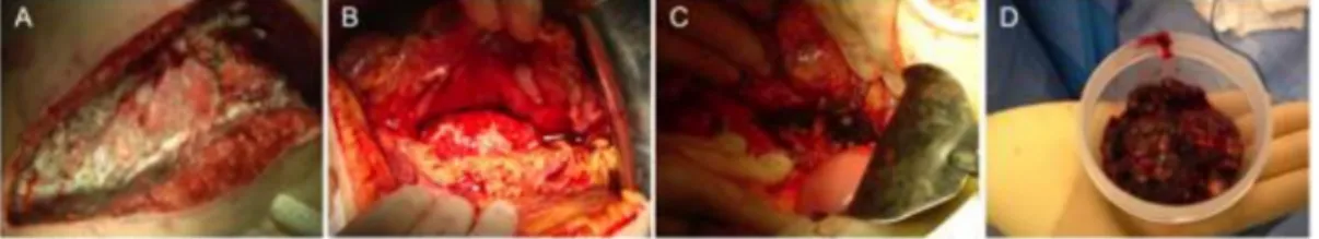 Figure 1. Open necrosectomy (sequential steps). (A) Transverse laparotomy, (B) retrogastric approach, (C) major artery skeletonized, and (D) necrosectomy specimen.