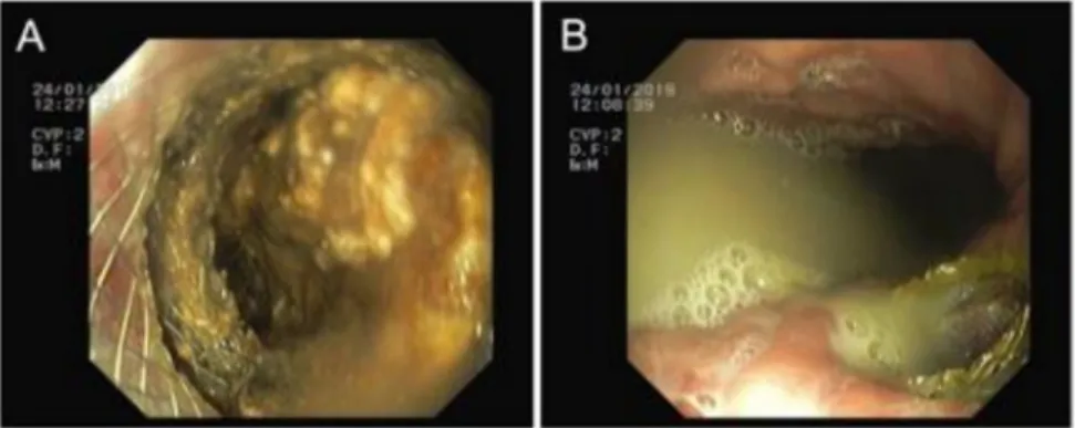 Figure 3. Transmural route. (A) Necrosectomy through the prosthesis and (B) purulent drainage to the gastric lumen.