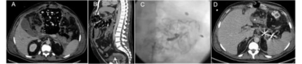 Figure 6. Splenic artery trans-arterial embolization by the placement of coils in a patient with acute pancreatitis patient submitted to an “open abdomen” tamponade for hemorrhage control