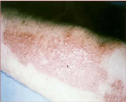 Figure 2. Linear dermatitis on an arm caused by Paederus fuscipes (northern Iran). 
