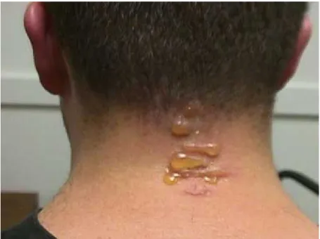 Figure 4. Blistering symptom provoked by a meloid beetle. 