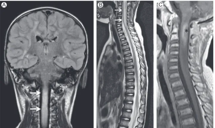 Figure 7 Radiation therapy-related myelopathy. Brain MRI coronal FLAIR (A), spine MRI midsagittal T2 (B) and midsagittal postcontrast T1-WI (C) of a patient who underwent radiation therapy
