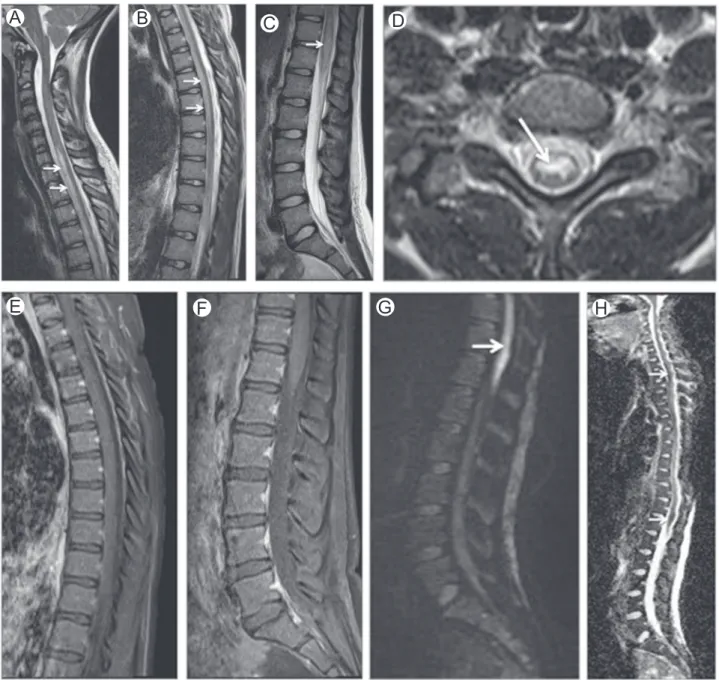 Figure 8 Spinal sea stroke. Sagittal T2-WI at the level of the cervical (A), thoracic (B), and lumbar (C) spine and axial T2-WI (D) show high T2-WI signal intensity in the anterior two-third of the cord