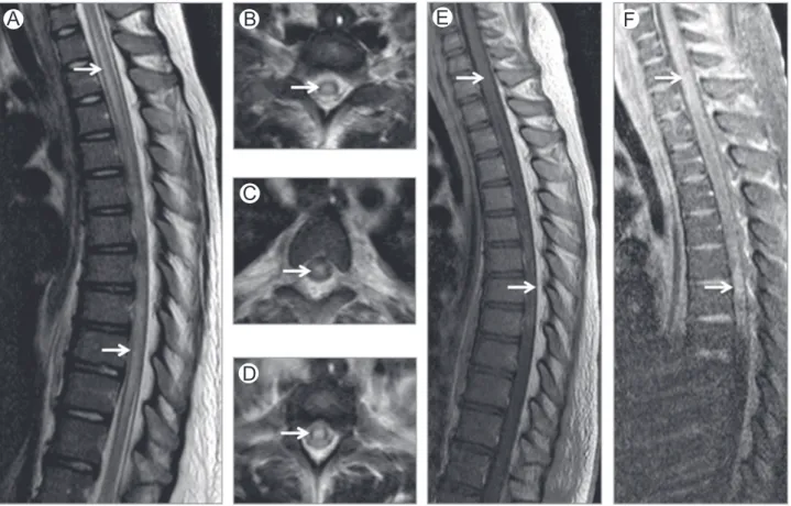 Figure 9 Ketoacidosis myelopathy. Sagittal (A) and axial (B-D) T2-WI of thoracic spine show high T2-WI signal intensity involving the central aspect of the cord (arrows)