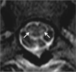 Figure 10 Spinal cord decompression sickness. Axial T2-WI at level of thoracic spine shows high-signal intensity in the dorsolateral white matter tracts