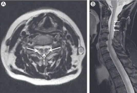 Figure 2 Vitamin B 12 deﬁciency. Axial (A and B) and sagittal (C) T2-WI in a patient with vitamin B 12 deﬁciency show high- high-signal intensity involving the dorsal columns (arrows)