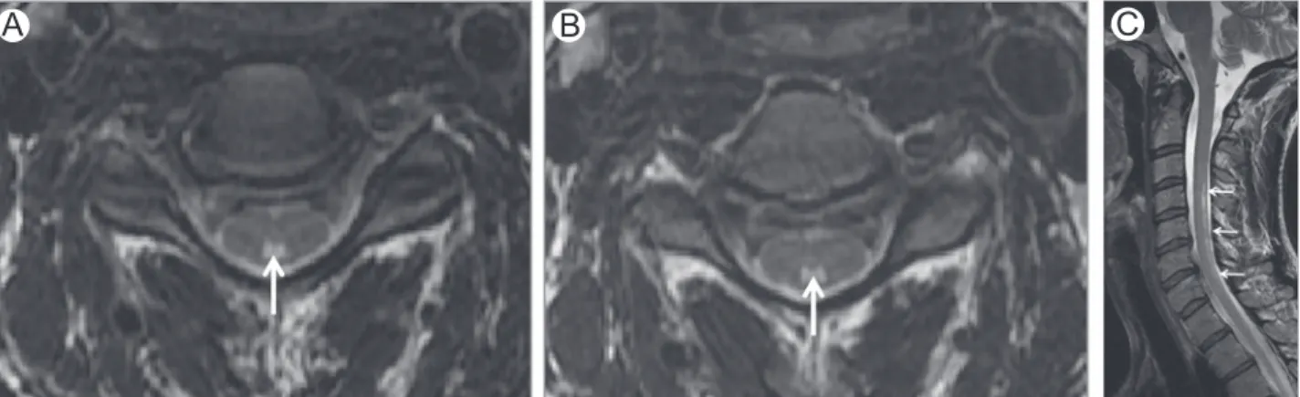 Figure 3 Nitrous oxide toxicity. Axial (A and B) and sagittal (C) T2-WI of the cervical spine in a patient with myelopathy after surgery with nitrous oxide anesthesia