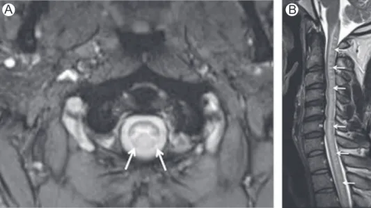 Figure 4 Folate de ﬁ ciency. Axial (A) and sagittal (B) T2-WI in a patient with folate de ﬁ ciency show high-signal intensity involving the dorsal columns (arrows).