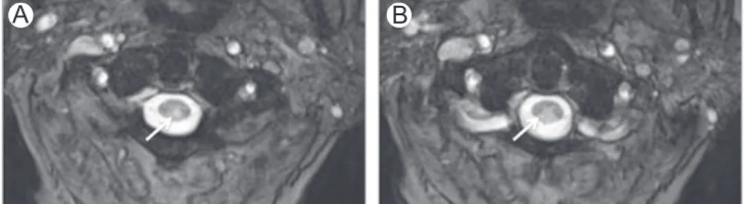 Figure 5 Copper de ﬁ ciency. (A and B) Axial T2-WI at C1-2 level in a patient with Cu de ﬁ ciency demonstrate high-signal intensity involving dorsal columns (arrows).