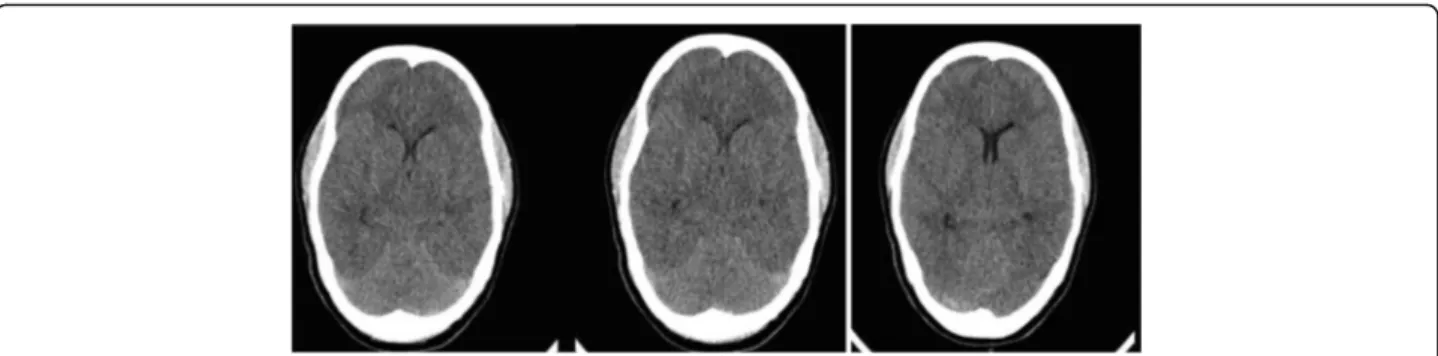 Fig. 2 Computerized axial tomography with diffuse cerebral edema, showing loss of differentiation between grey and white matter and compression of the ventricles