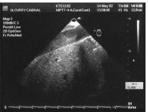 Fig. 3  Transesophageal echocar- echocar-diogram at 0º, showing the  free-floating tubular mass in the right atrium, linear in Fig