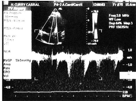 Fig. 5  Hipertensão pulmonar aos oito dias de heparina, com uma dilatação das cavidades direitas maior que no ecocardiograma de entrada.