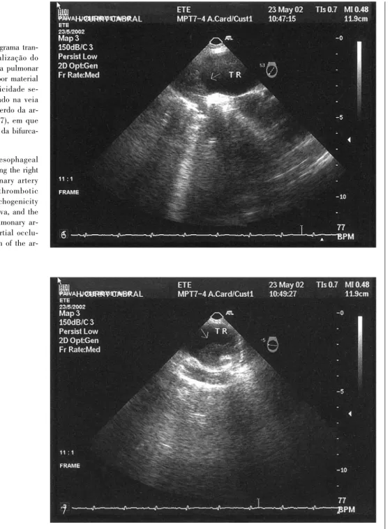 Fig. 6 e 7  Ecocardiograma tran- tran-sesofágico com visualização do ramo direito da artéria pulmonar (Fig