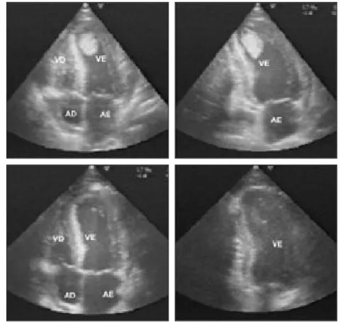 Fig. 2 Ecocardiograma transtorácico:  imagens em apical 4 câmaras (à esquerda) e apical duas câmaras modificado (à direita) que mostram trombo volumoso, pediculado e móvel ocupando o ápex do ventrículo esquerdo