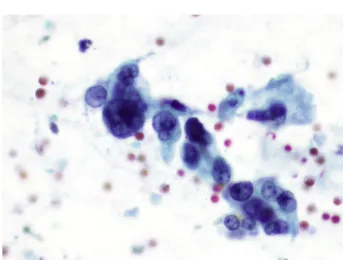 Figure 3 Pancreatic aspiration cytology, Papanicolaou stain 10 × 40: small tridimensional aggregate showing atypical cells of adenocarcinoma, displaying nuclear pleomorphism and  hyper-chromasia.
