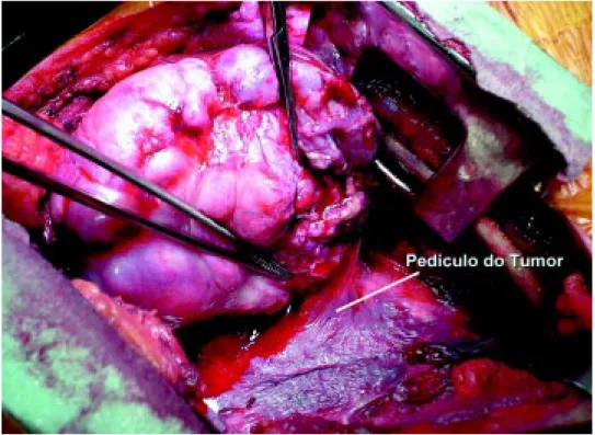 Fig. 5 — Aspecto cirúrgico do pedículo em TFLP gigante.