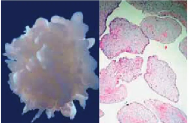 Figura 6. Imagem de fibroelastoma: à directa, peça anatómica extraída  cirurgicamente  com  aspecto  típico  deste  tumor;  à esquerda, o seu exame histológico