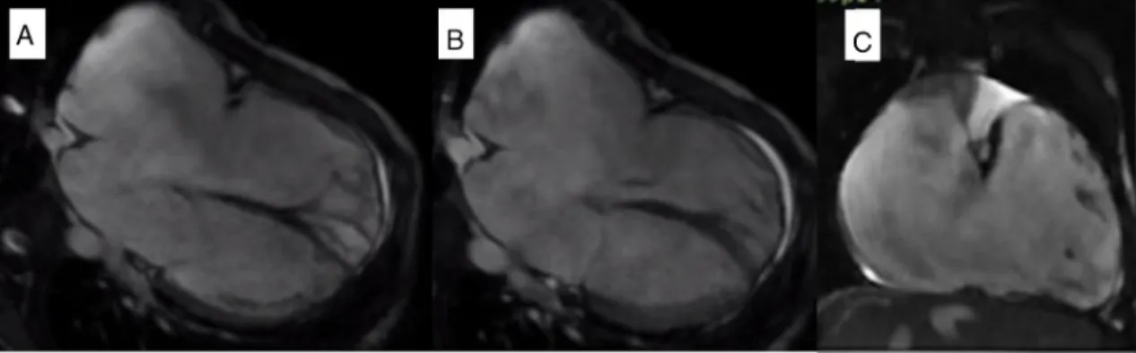 Figure 2 Cardiovascular magnetic resonance: Steady-state free precession imaging documenting severe dilation of the right atrium and right ventricle, an extremely thin-walled right ventricle with almost complete absence of the right ventricular free wall m