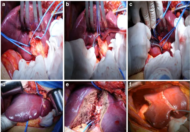 Fig. 5 An extended right posterior sectionectomy was performed in a patient with liver metastasis