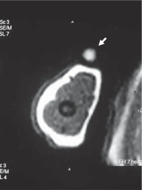 Fig. 1.   MR image: the hyper-signal of lecithin beacons the most  appropriate transaxial image