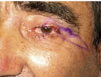 Figure 2 Case 1. (Left [Figure 2a]) The resulting defect represents approximately 40% of the original width of the eyelid