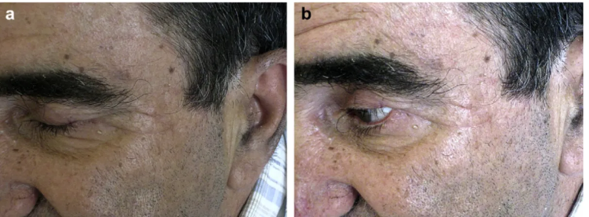 Figure 3 Case 1. One year after surgery, no recurrence is observed. Eyelid function is normal