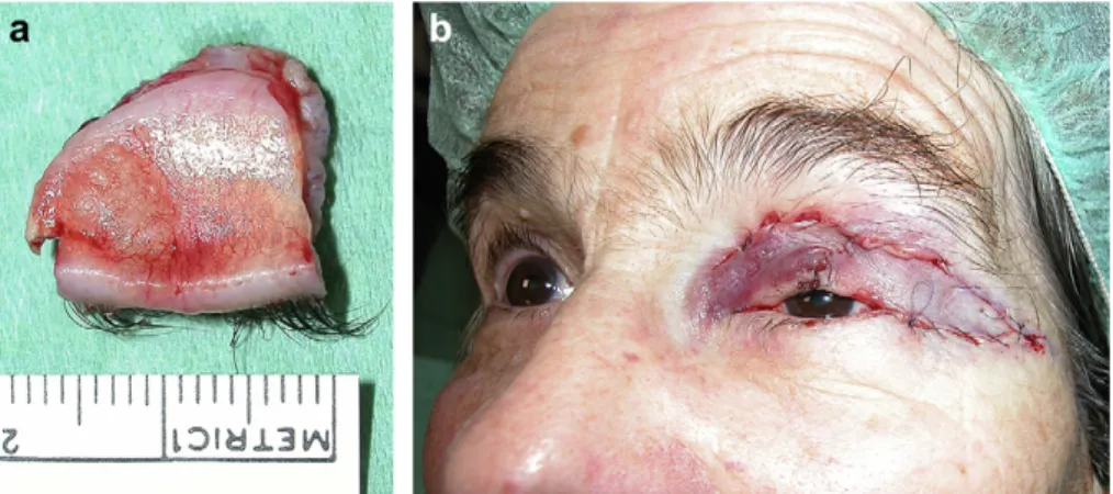 Figure 6 Case 2. One year after surgery, no recurrence or impairment of eyelid function are observed