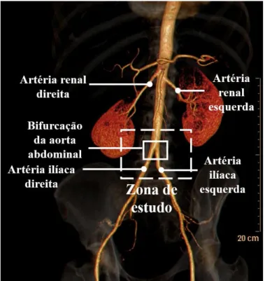 Figura 1-Modelo da aorta abdominal, do paciente em estudo,  com as respetivas divisões