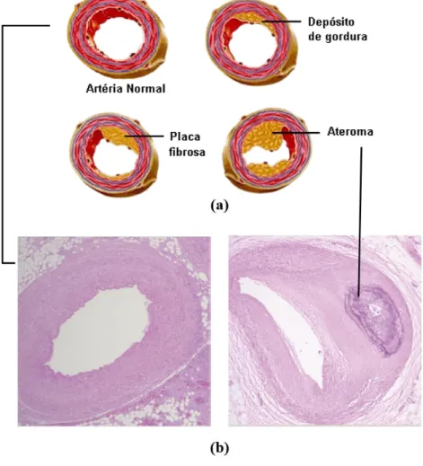 Figura 5- a) Representação esquemática da formação de um ateroma 2 e b)  imagem real histológica de uma artéria normal e com um ateroma, retirada de  Wang et al., (2017) e alterada