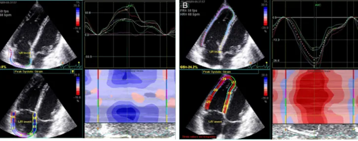 Figure 1 Right atrial (A) and right ventricular (B) strain measurements by two-dimensional speckle tracking echocardiography.