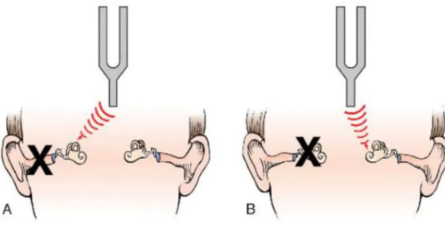 Figura 8 - Teste de Weber mostrando perda auditiva  (Swartz, 2015) 